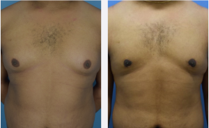 Male Breast Reduction Before & After Patient Miniature Set