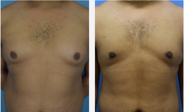 Photo of the patient’s body before & after the Male Breast Reduction surgery. Set 1: Patient 3