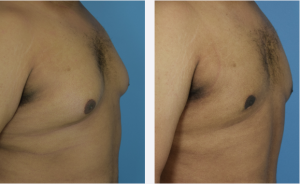 Male Breast Reduction Before & After Patient Miniature Set
