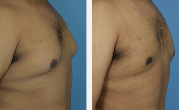 Photo of the patient’s body before & after the Male Breast Reduction surgery. Set 2: Patient 3
