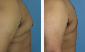 Male Breast Reduction Before & After Patient Miniature Set