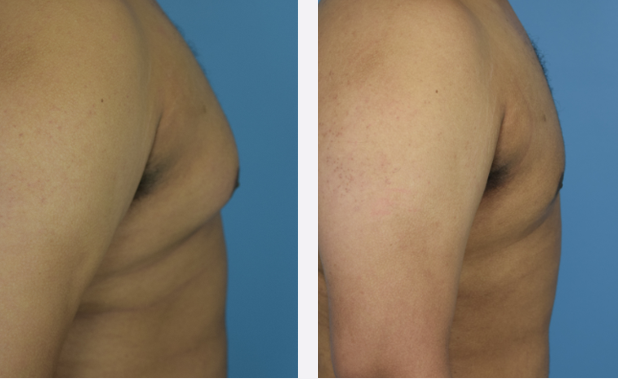 Photo of the patient’s body before & after the Male Breast Reduction surgery. Set 3: Patient 3