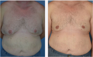Male Breast Reduction Before & After Patient Miniature Set