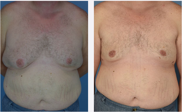 Photo of the patient’s body before & after the Male Breast Reduction surgery. Set 1: Patient 4