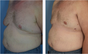 Male Breast Reduction Before & After Patient Miniature Set