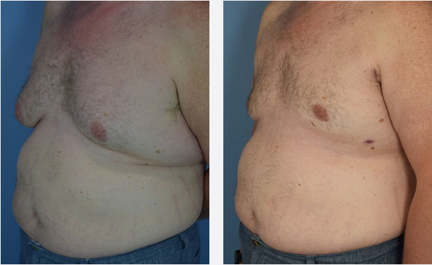 Photo of the patient’s body before & after the Male Breast Reduction surgery. Set 2: Patient 4
