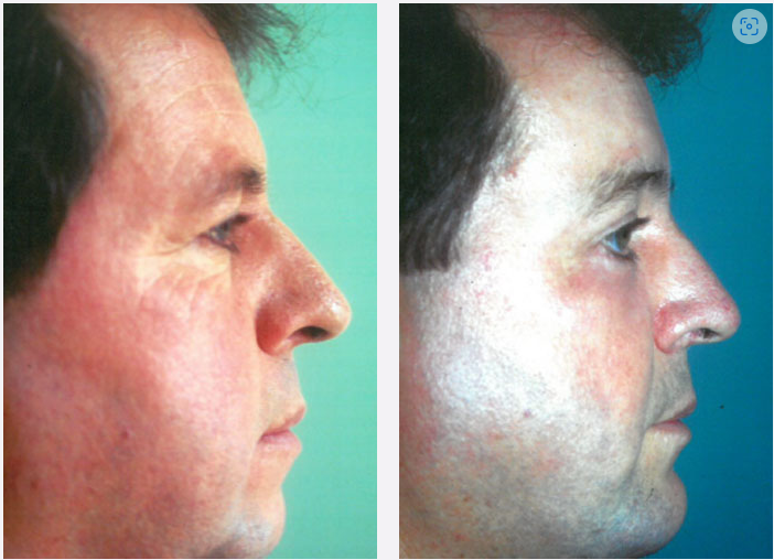 Photo of the patient’s face before & after the Male Rhinoplastyt surgery. Set 1: Patient 1