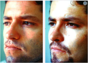 Male Rhinoplasty Before & After Patient Miniature Set
