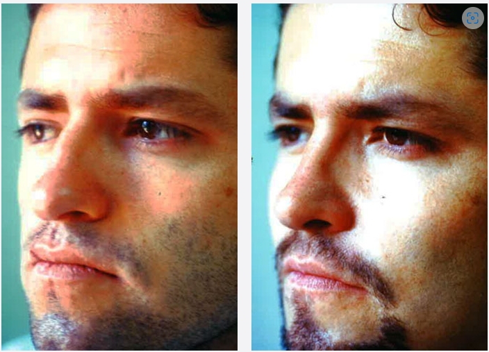 Photo of the patient’s face before & after the Male Rhinoplastyt surgery. Set 1: Patient 2