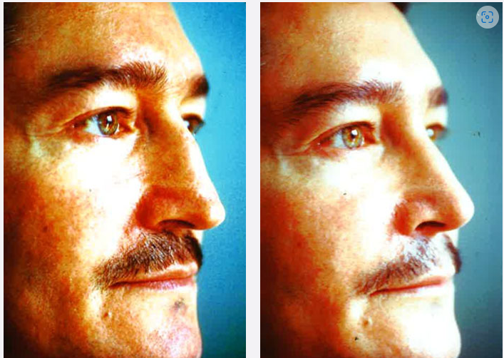 Photo of the patient’s face before & after the Male Rhinoplastyt surgery. Set 1: Patient 3