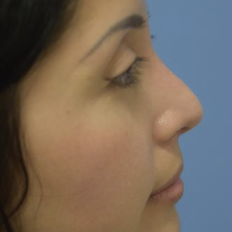 Female face, after Rhinoplasty treatment, r-side view, patient 1