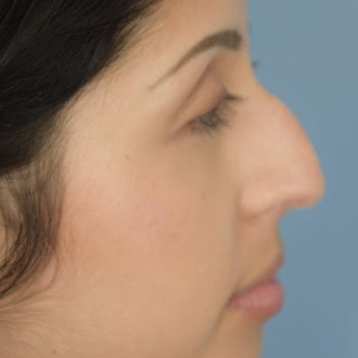Female face, before Rhinoplasty treatment, r-side view, patient 1
