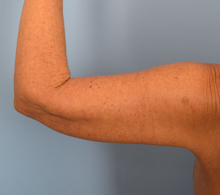 Arm Lift Before & After Patient Set