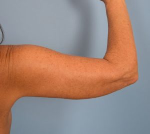 Arm Lift Before & After Patient Miniature Set