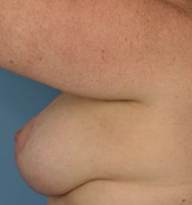 Breast Lift Before & After Patient Miniature Set