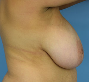 Breast Reduction Before & After Patient Miniature Set