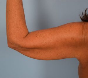 Arm Lift Before & After Patient Miniature Set