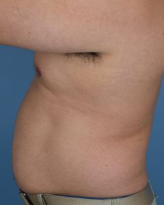 Liposuction Before & After Patient Miniature Set
