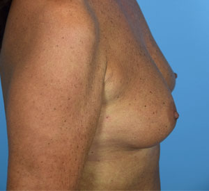 Breast Augmentation with Fat Before & After Patient Set