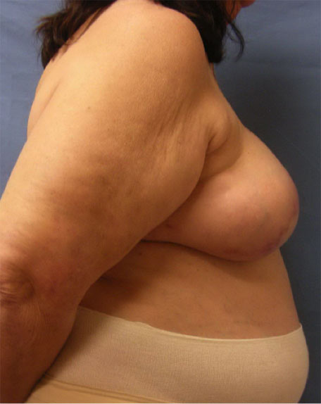 Breast Reconstruction Before & After Patient Set