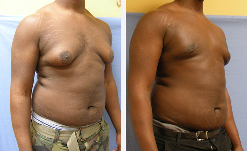 Photo of the patient’s body before & after the Male Breast Reduction surgery. Set 5: Patient 2