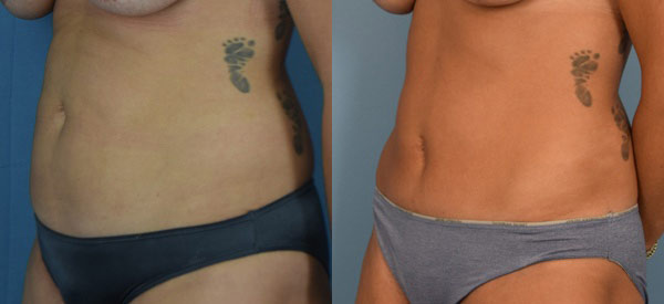 Female body, before and after Tummy Tuck treatment, l-side oblique view, patient 15