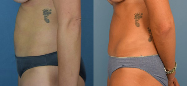 Female body, before and after Tummy Tuck treatment, l-side view, patient 15