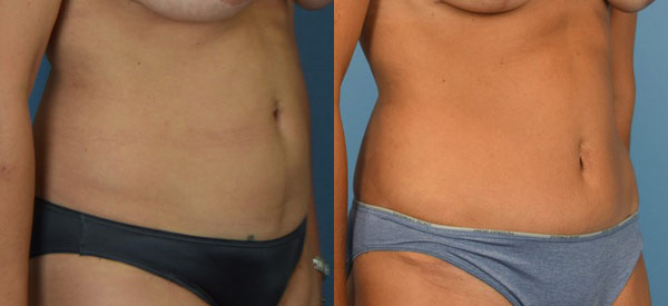 Female body, before and after Tummy Tuck treatment, r-side oblique view, patient 15