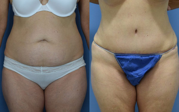 Female body, before and after Tummy Tuck treatment, front view, patient 2
