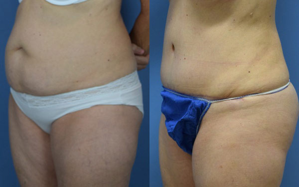 Female body, before and after Tummy Tuck treatment, l-side oblique view, patient 2