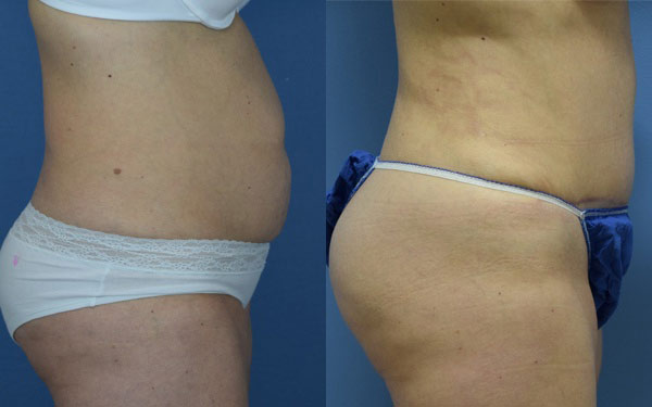 Female body, before and after Tummy Tuck treatment, r-side view, patient 2