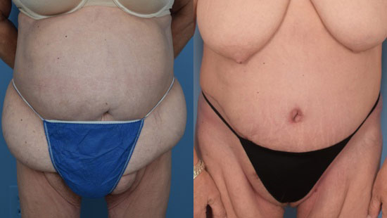Female body, before and after Tummy Tuck treatment, front view, patient 38