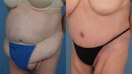 Female body, before and after Tummy Tuck treatment, l-side oblique view, patient 38
