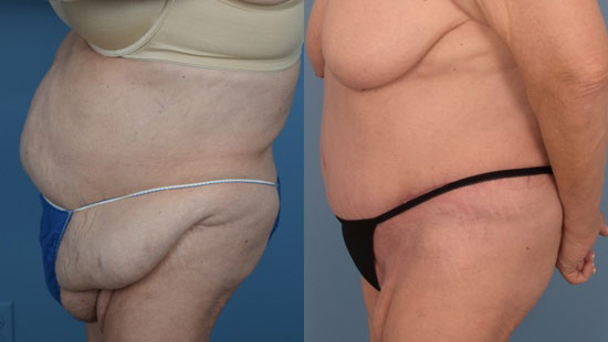 Female body, before and after Tummy Tuck treatment, l-side view, patient 38