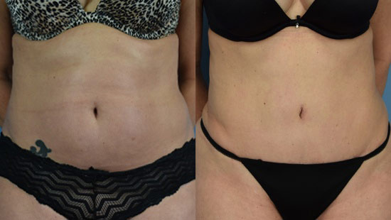 Female body, before and after Tummy Tuck treatment, front view, patient 16