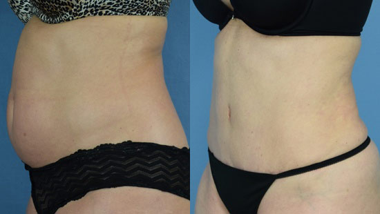 Female body, before and after Tummy Tuck treatment, l-side oblique view, patient 16