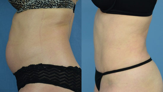 Female body, before and after Tummy Tuck treatment, l-side view, patient 16