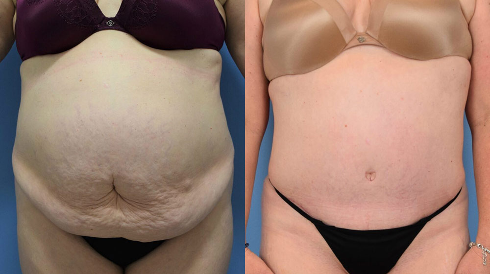 Female body, before and after Tummy Tuck treatment, front view, patient 17