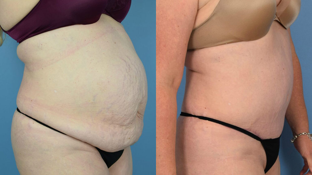 Female body, before and after Tummy Tuck treatment, r-side oblique view, patient 17