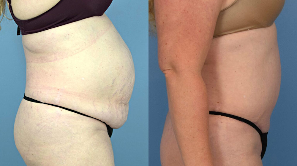 Female body, before and after Tummy Tuck treatment, r-side view, patient 17