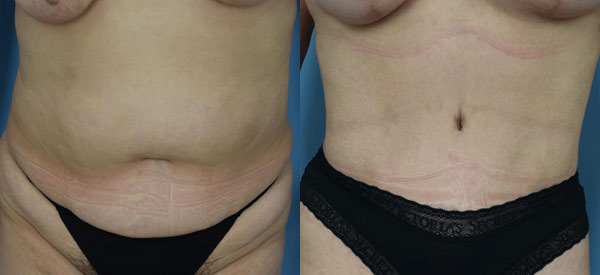 Female body, before and after Tummy Tuck treatment, front view, patient 18