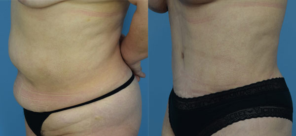 Female body, before and after Tummy Tuck treatment, l-side oblique view, patient 18