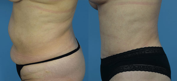 Female body, before and after Tummy Tuck treatment, l-side view, patient 18