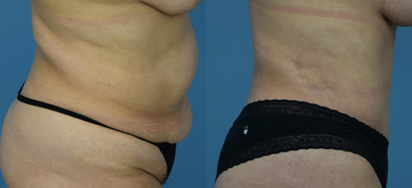 Female body, before and after Tummy Tuck treatment, r-side view, patient 18