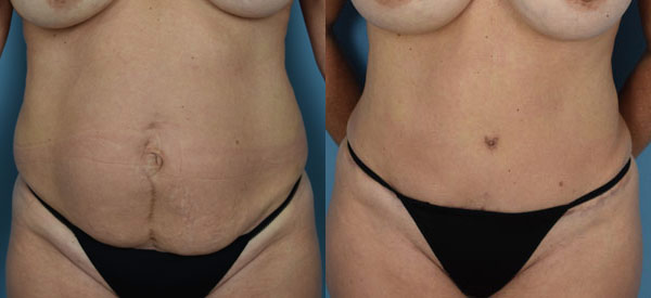 Female body, before and after Tummy Tuck treatment, front view, patient 8