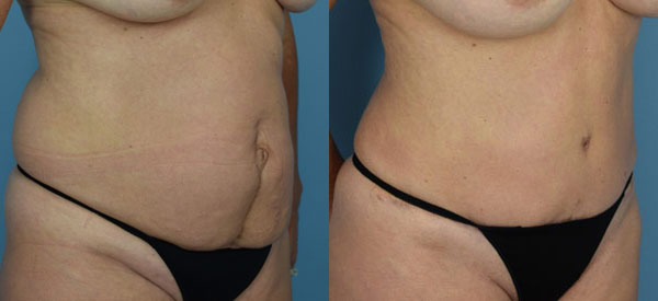 Female body, before and after Tummy Tuck treatment, r-side oblique view, patient 8