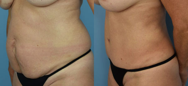 Female body, before and after Tummy Tuck treatment, l-side oblique view, patient 8