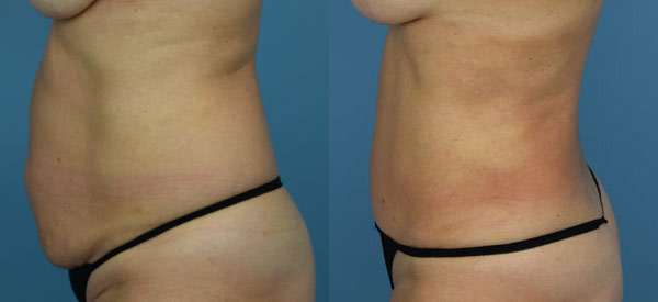 Female body, before and after Tummy Tuck treatment, l-side view, patient 8