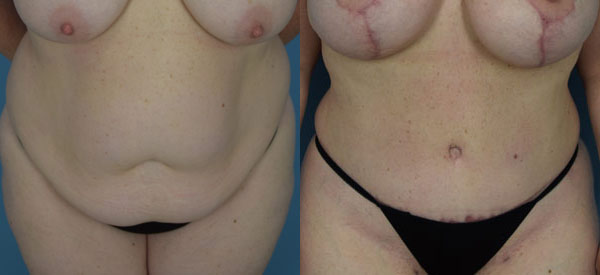 Female body, before and after Tummy Tuck treatment, front view, patient 19