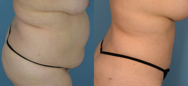 Female body, before and after Tummy Tuck treatment, r-side view, patient 19
